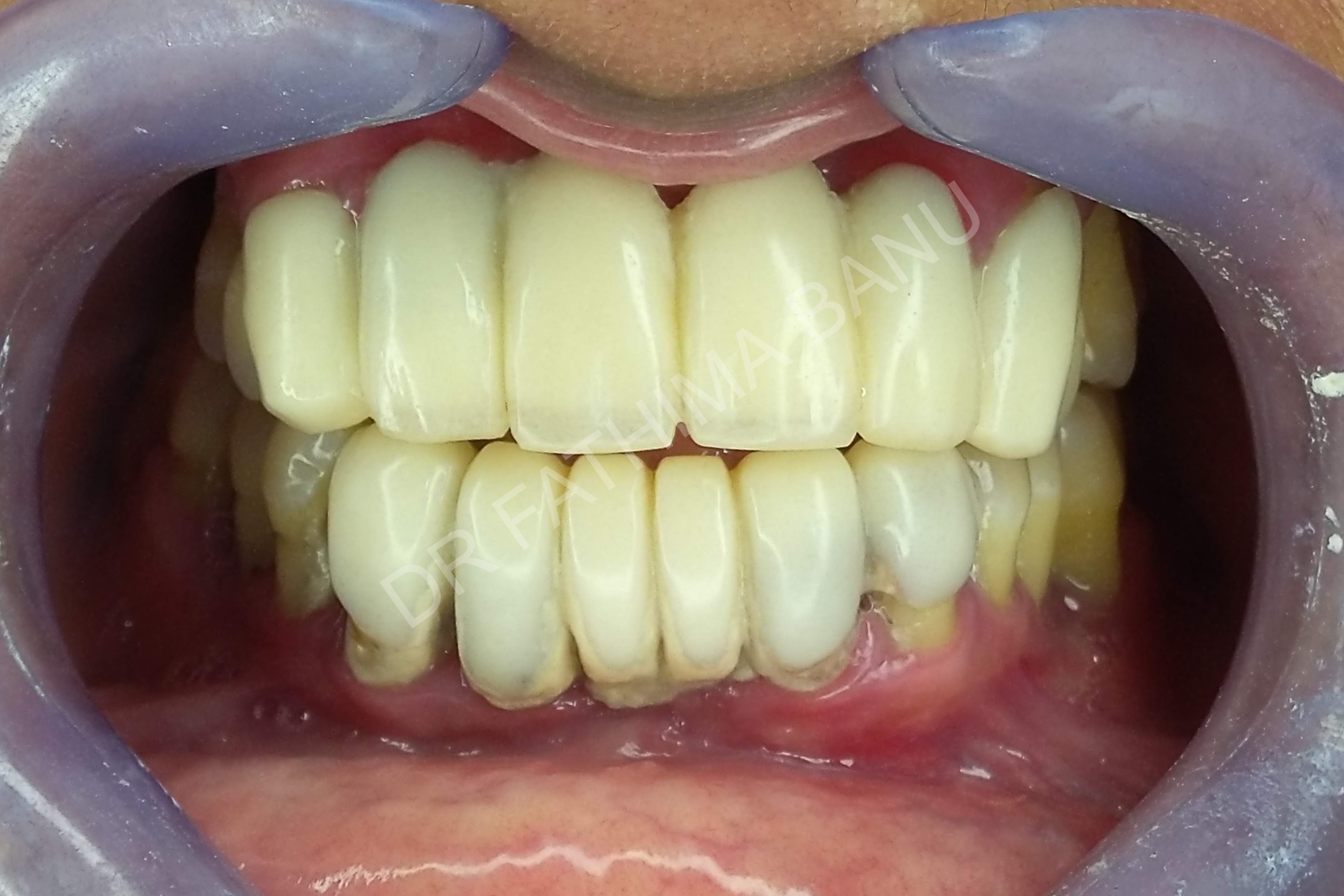 Zirconia prosthesis Before