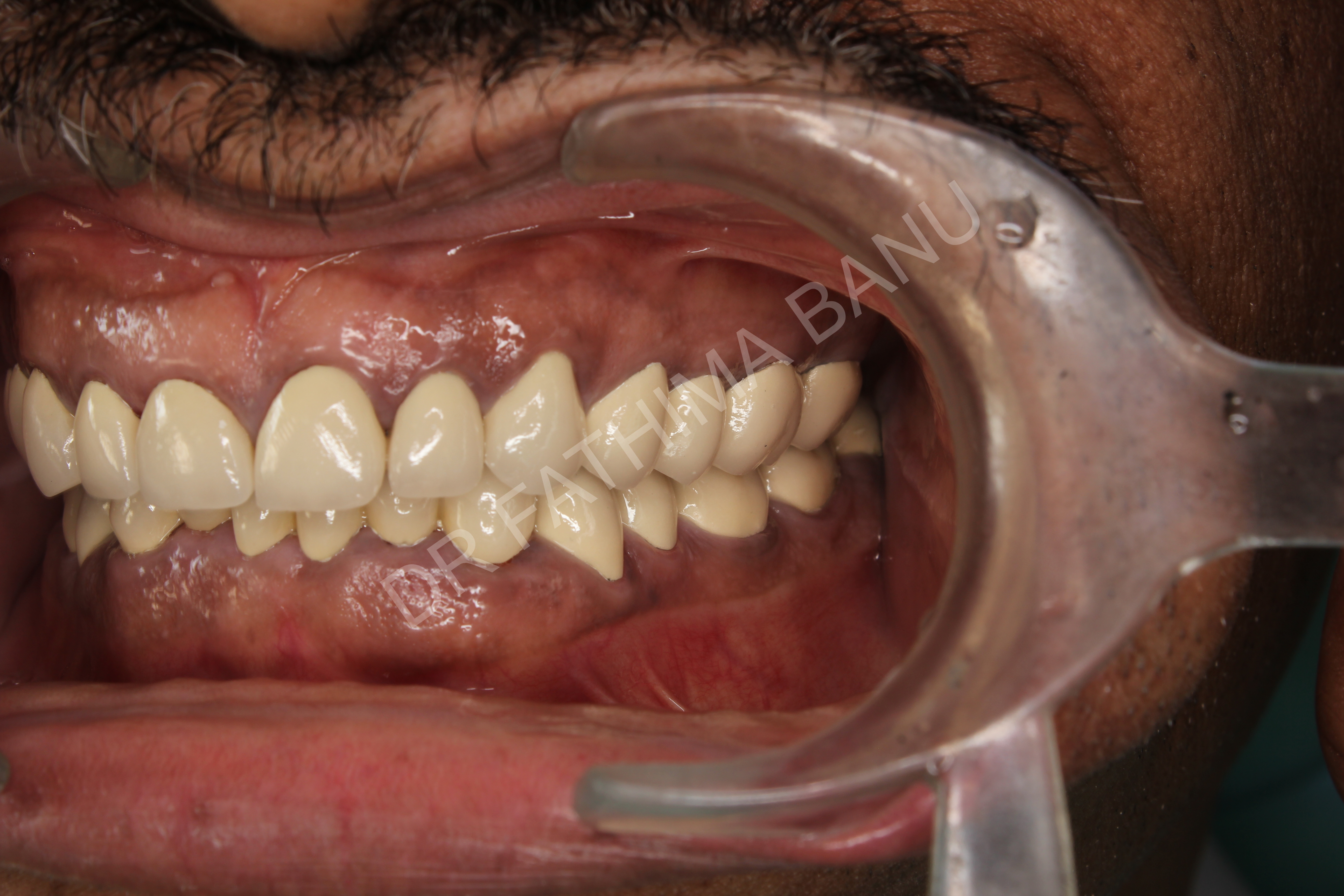 Full mouth rehabilitation After