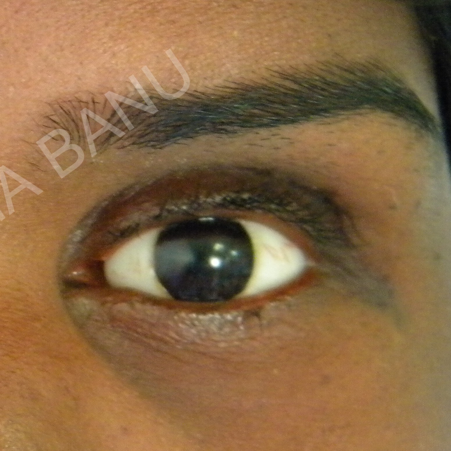 Eye prosthesis After