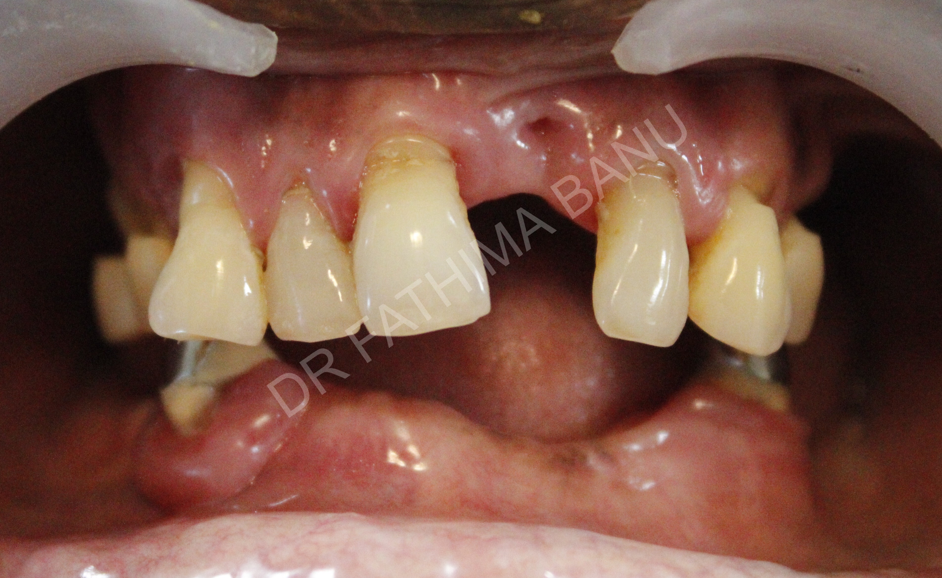 Implant supported hybrid prosthesis Before