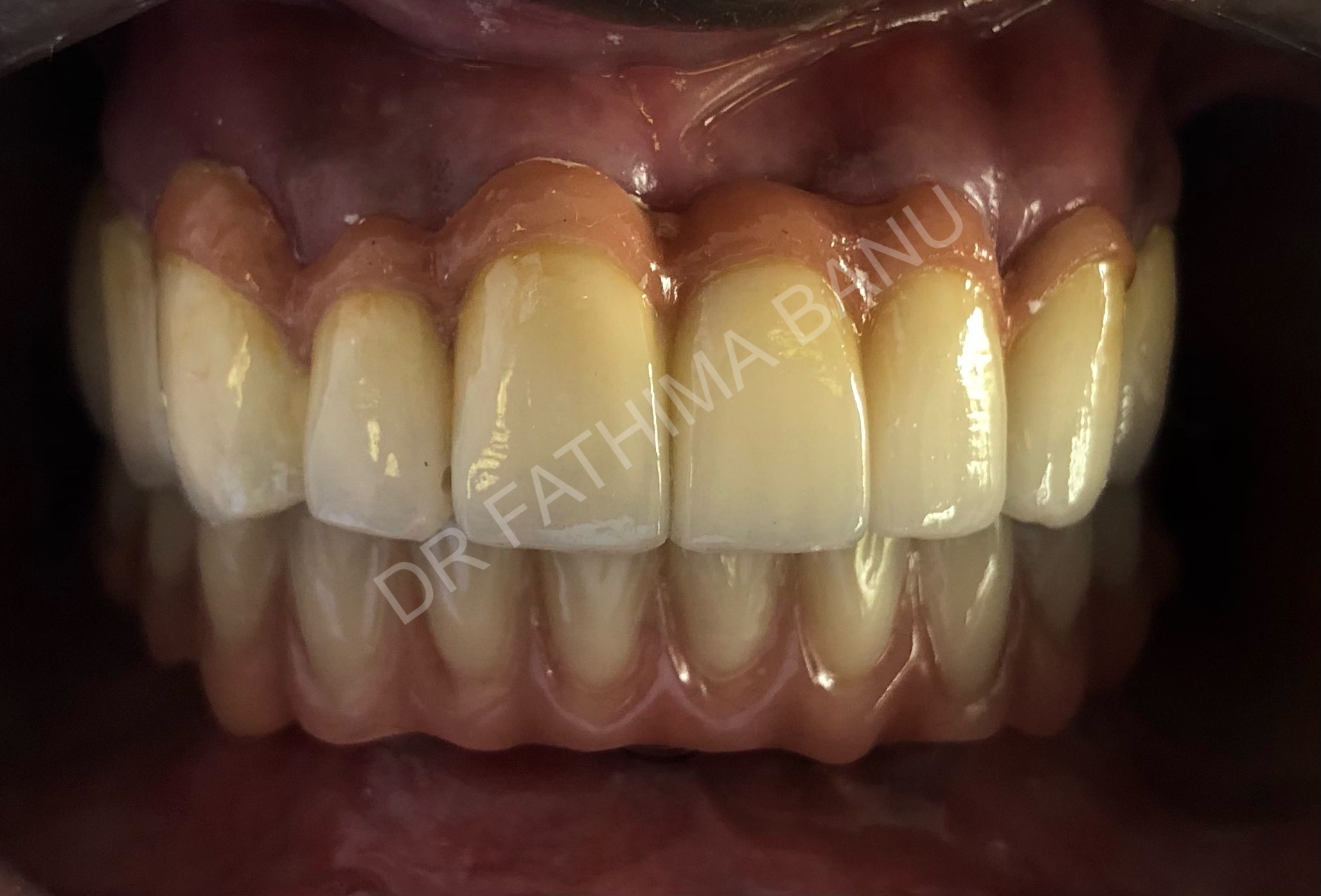 Implant supported hybrid prosthesis After