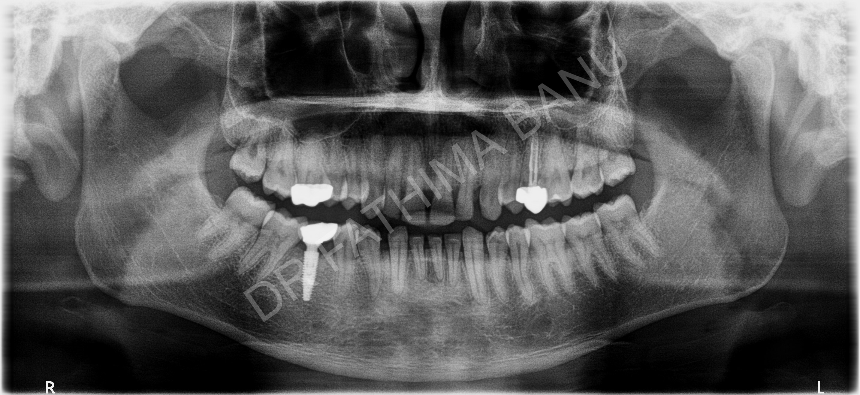 Dental Implant Case