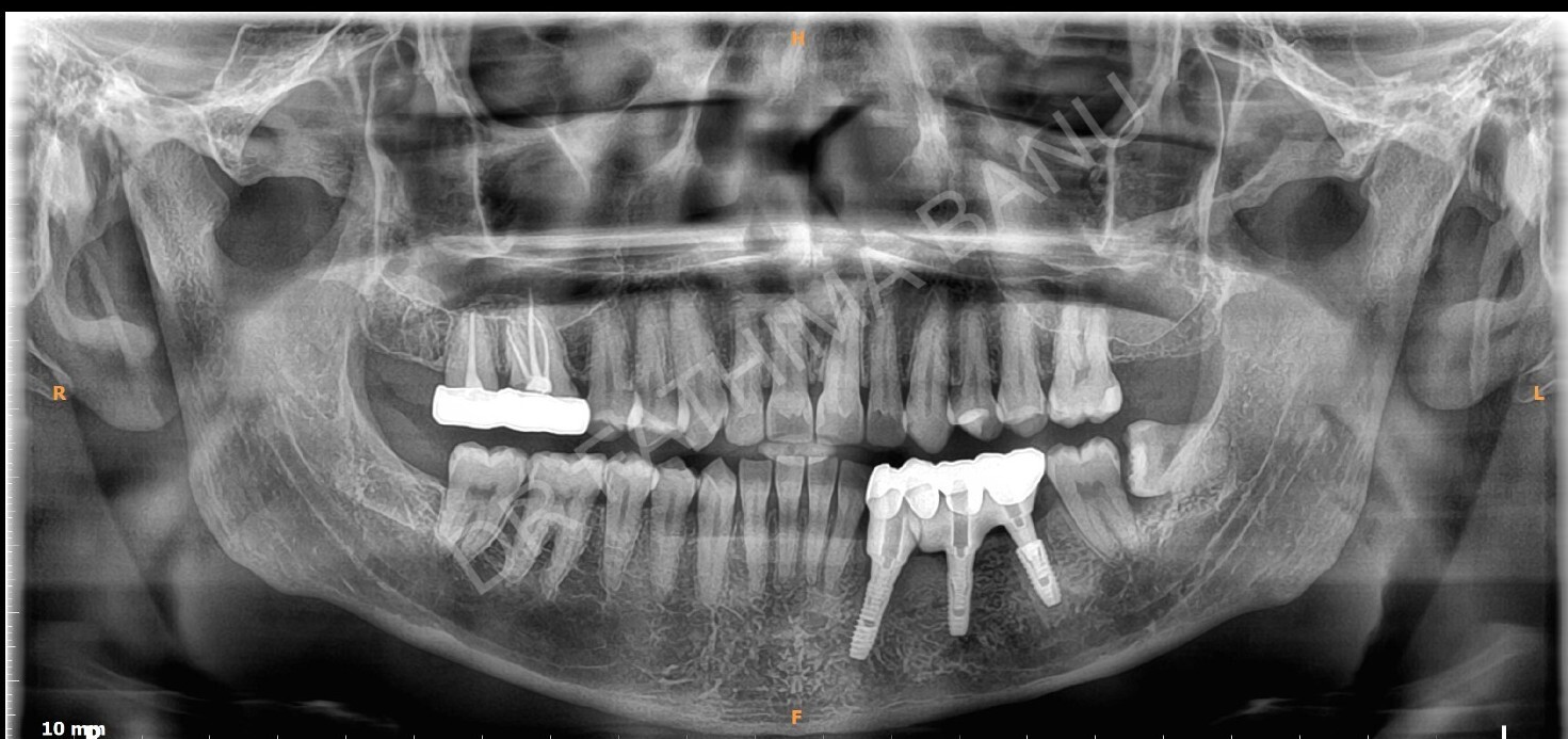 Dental Implant Case