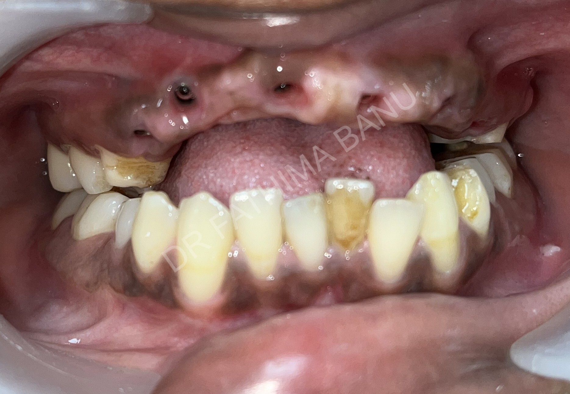 Implant supported fixed ceramic prosthesis Before